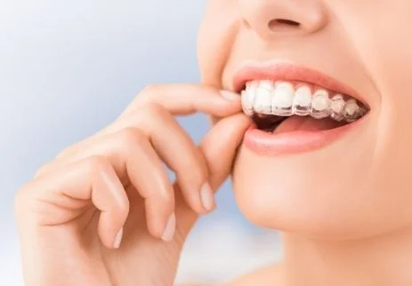 İnvisalign Tedavi Süresi Nedir