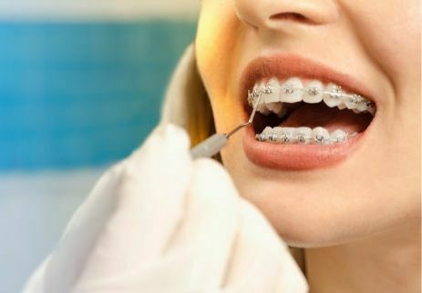 Ortodontik Tedavide Kullanılan Apareyler Nelerdir