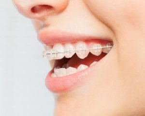 Şeffaf Diş (Porselen) Teli Tedavisi
